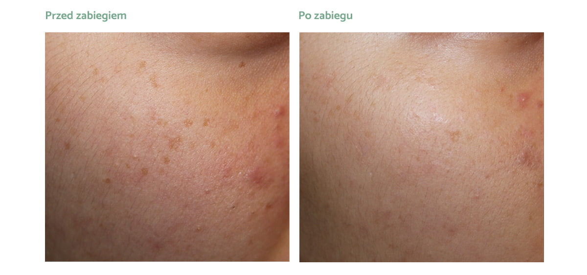 PicoPlus_rezultaty_zabiegow PicoPlus_rezultaty_zabiegow