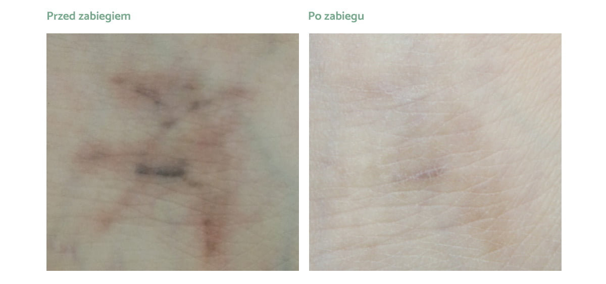 PicoPlus_rezultaty_zabiegow_2 PicoPlus_rezultaty_zabiegow_2