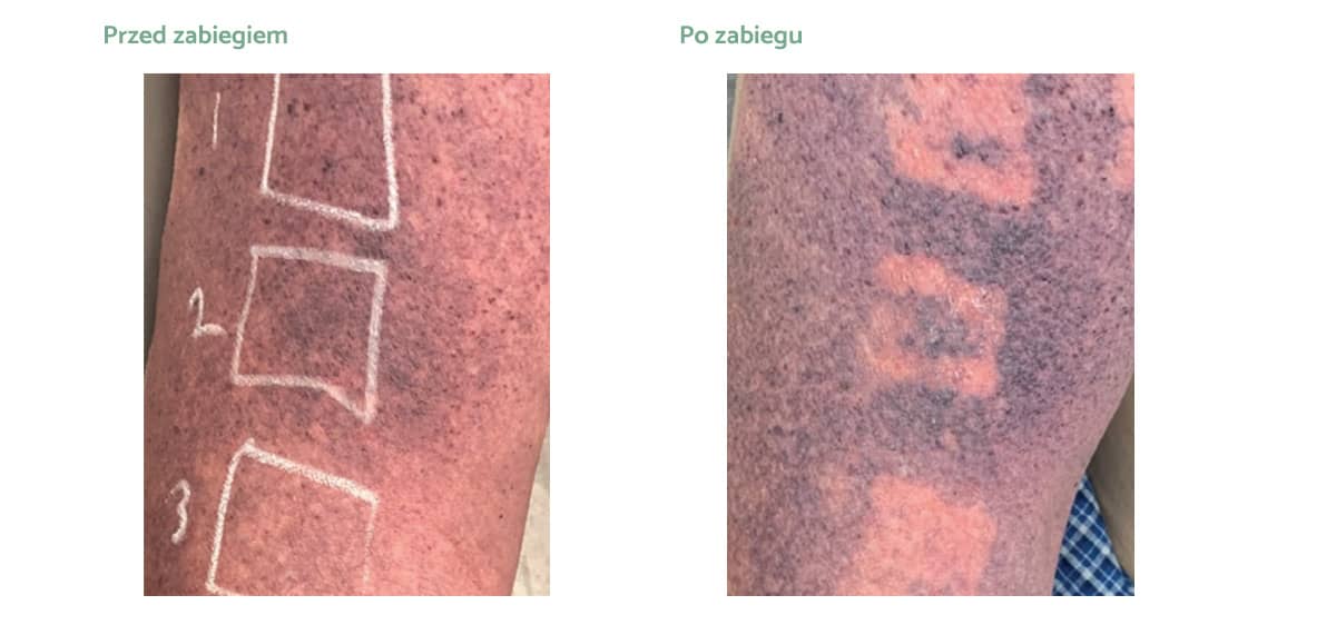 derma-v-rezultaty_zabiegow-01 derma-v-rezultaty_zabiegow-01