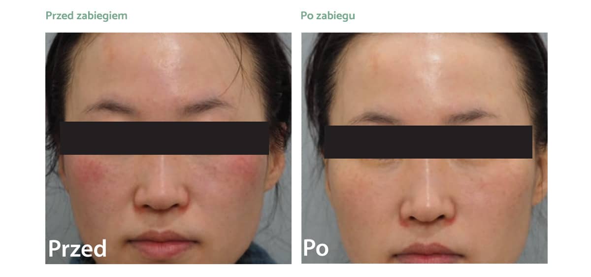 derma-v-rezultaty_zabiegow-02 derma-v-rezultaty_zabiegow-02