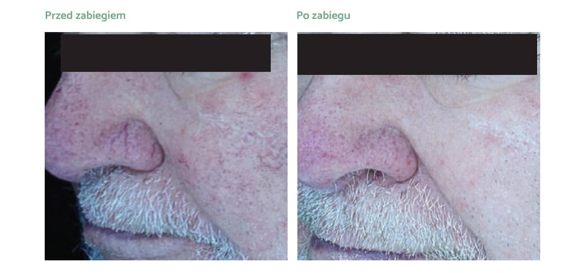 derma-v-rezultaty_zabiegow-03 derma-v-rezultaty_zabiegow-03