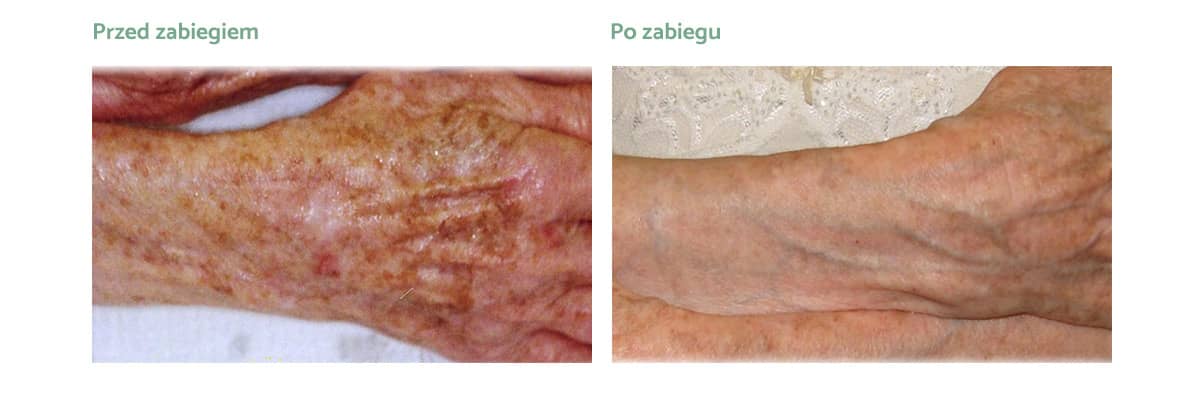 eco2-plus-rezultaty_zabiegow-004 eco2-plus-rezultaty_zabiegow-004
