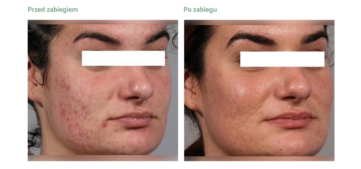 endymed-pro-rezultaty-001 endymed-pro-rezultaty-001