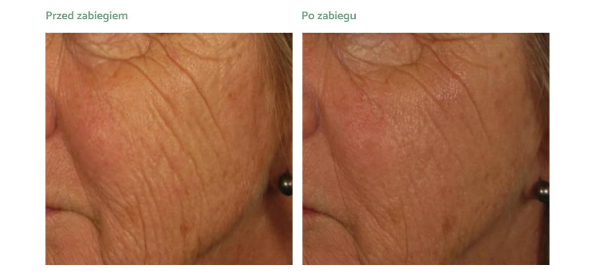 endymed-pro-rezultaty-002 endymed-pro-rezultaty-002
