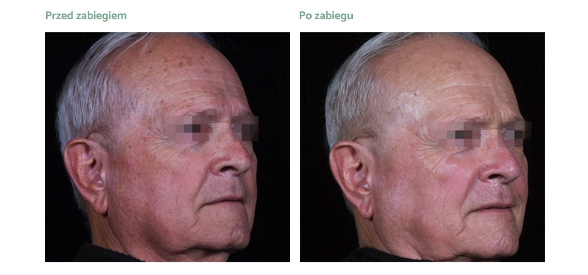 excel-v-plus-rezultat-zabiegowy-01 excel-v-plus-rezultat-zabiegowy-01