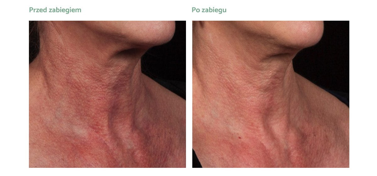 excel-v-plus-rezultat-zabiegowy-02 excel-v-plus-rezultat-zabiegowy-02