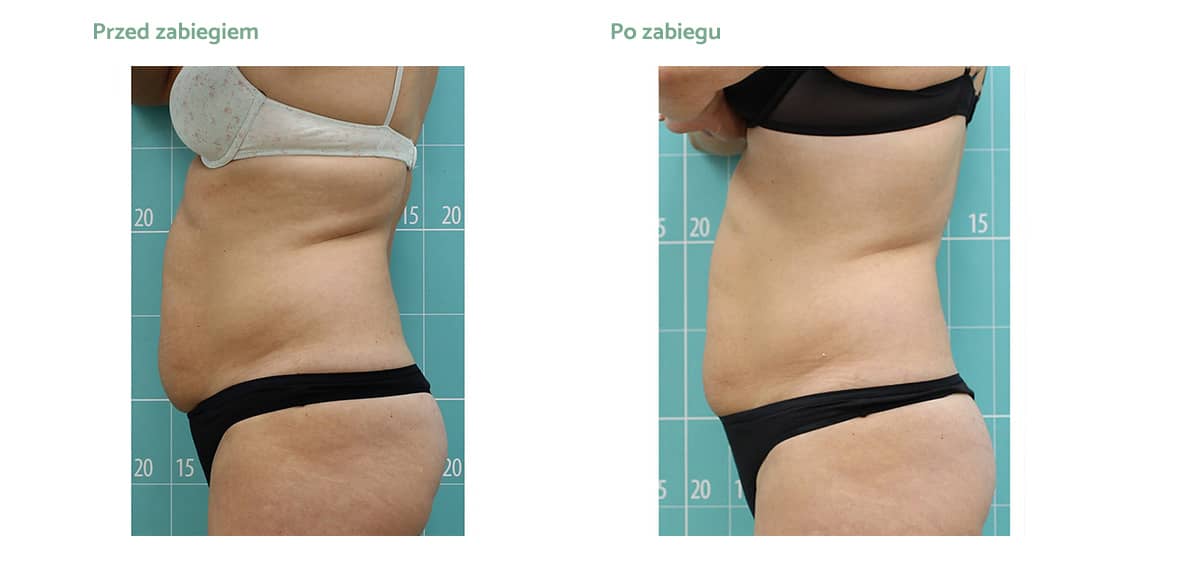 vmat-pro-rezutat-zabiegowy-01 vmat-pro-rezutat-zabiegowy-01