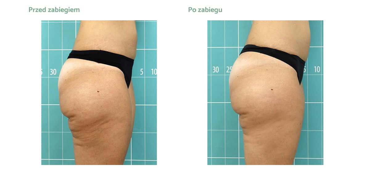 vmat-pro-rezutat-zabiegowy-02 vmat-pro-rezutat-zabiegowy-02